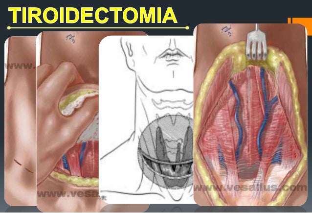 tiroidectomia